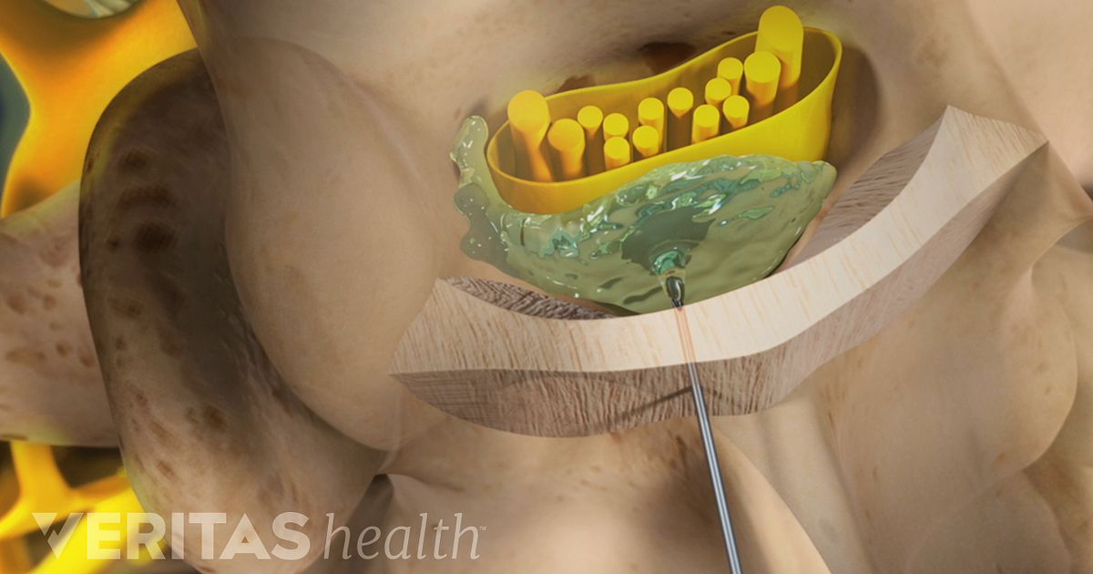 Inyeccion para hernias discales